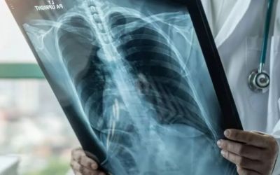 Câncer de pulmão: 30 mil novos casos por ano no Brasil, alerta Ministério da Saúde